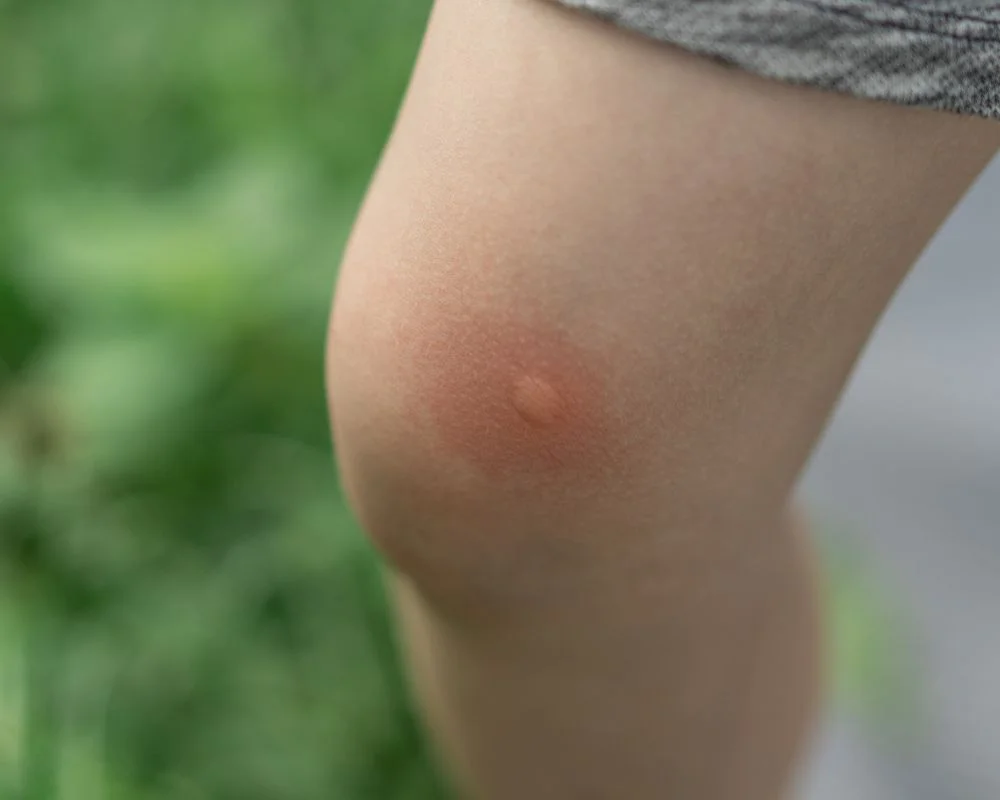 Protect Yourself From Mosquito Bites